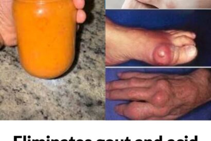 Thumbnail for Benefits of This Ingredient to Eliminate Gout and Uric Acid