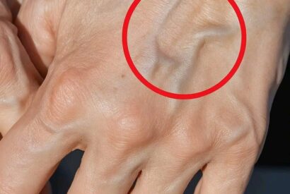 Thumbnail for Visible Veins What They Mean